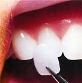Porcelain veneer being added to a tooth