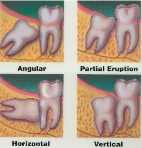 An illustration with four examples of impacted wisdom teeth. 