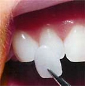 A porcelain veneer on a tooth