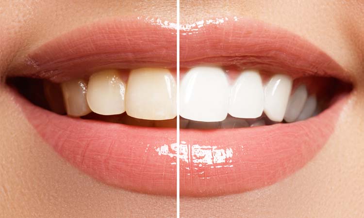 Over-the-Counter Teeth Whitening